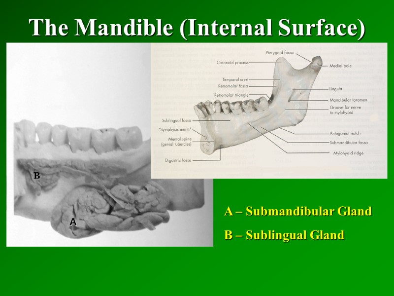 The Mandible (Internal Surface)   A B A – Submandibular Gland B –